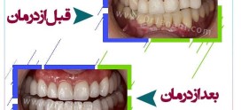 تفاوت ایمپلنت دندان با دندان مصنوعی