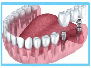 ایمپلنت دندان
