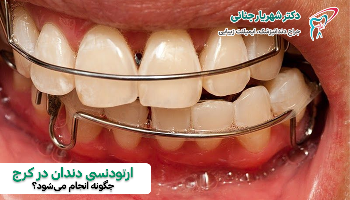 ارتودنسی دندان در کرج چگونه انجام می شود؟