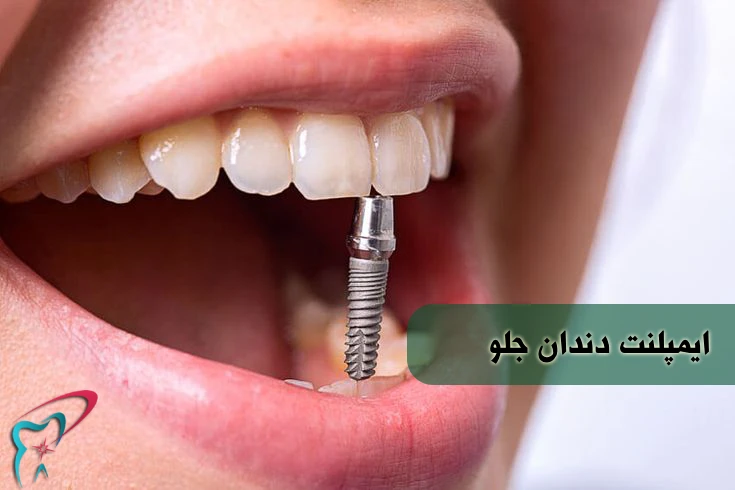ایمپلنت دندان جلو در کرج