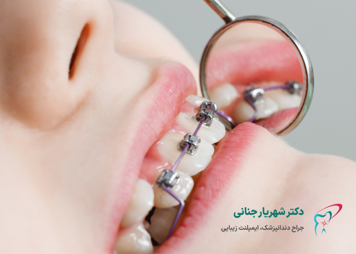 چه سنی برای ارتودنسی کودکان مناسب است؟