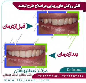 نمونه اصلاح طرح لبخند توسط دکتر شهریار جنانی