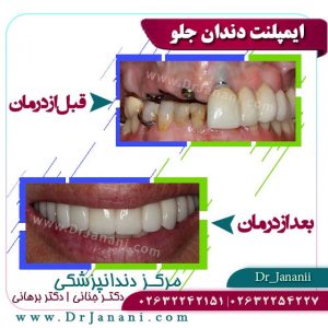 نمونه ایمپلنت دندان توسط دکتر شهریار جنانی