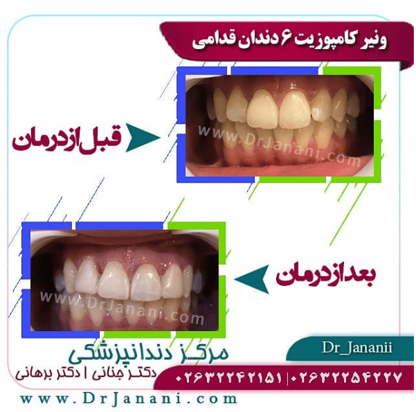 روکش دندان توسط دکتر شهریار جنانی