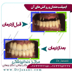 ایمپلنت دندان