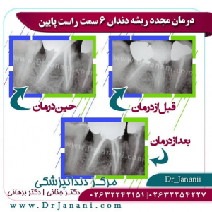 عصب کشی مجدد دندان توسط دکتر سروش برهانی