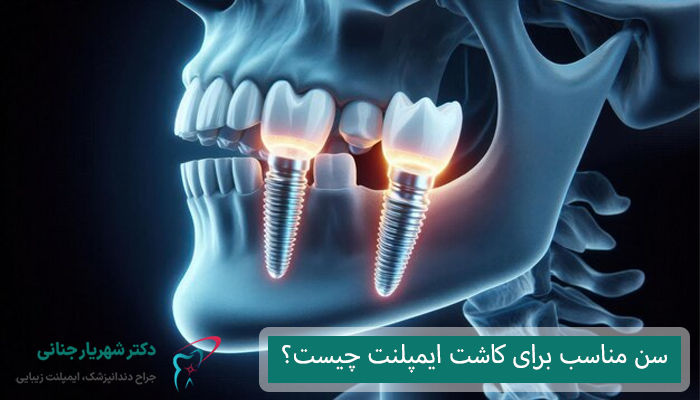 بهترین سن برای ایمپلنت دندان