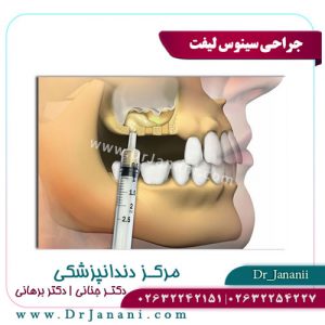 جراحی سینوس لیفت