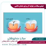 فیشورسیلانت و فواید آن برای دندان دائمی