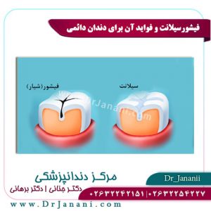 فیشورسیلانت و فواید آن برای دندان دائمی