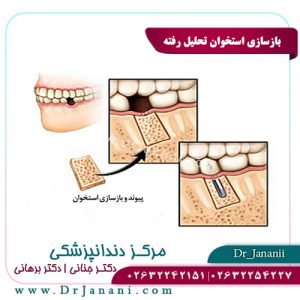 بازسازی استخوان تحلیل رفته