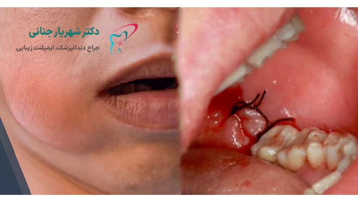 بعد از جراحی دندان عقل باید چه کار کنیم؟