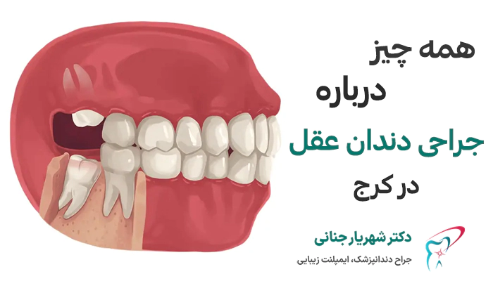 جراحی دندان عقل در کرج چگونه انجام میشود؟