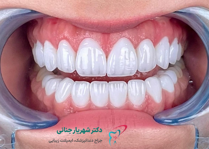 لمینت و کامپوزیت دندان چگونه انجام می شود؟
