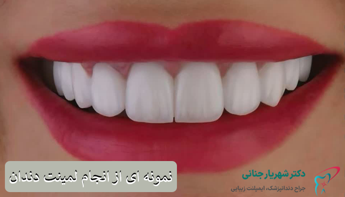 نمونه لمینت دندان
