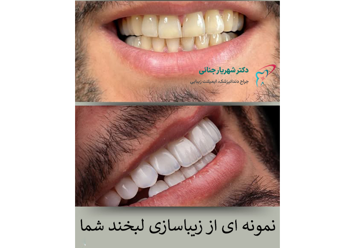 نمونه کامپوزیت دندان