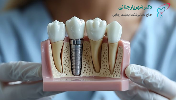 چرا کاشت ایمپلنت بعد از کشیدن دندان لازم است؟