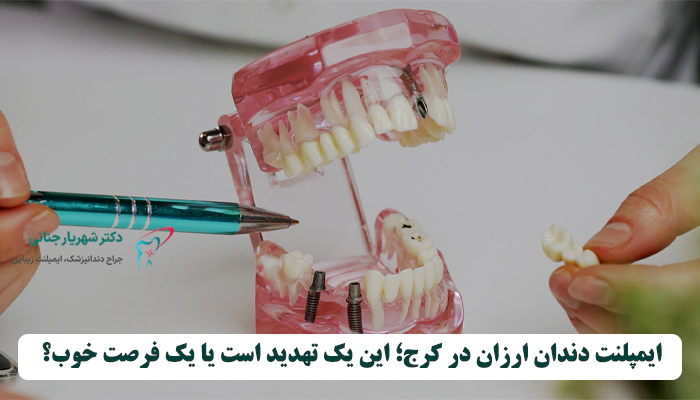 ایمپلنت دندان ارزان در کرج