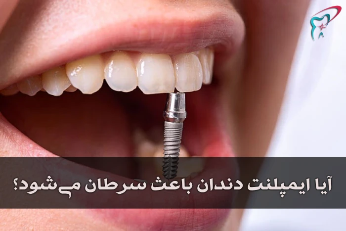 آیا ایمپلنت دندان باعث سرطان می‌شود؟