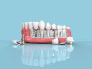 اجزای ایمپلنت دندان