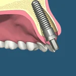 سخت ترین مرحله ایمپلنت دندان