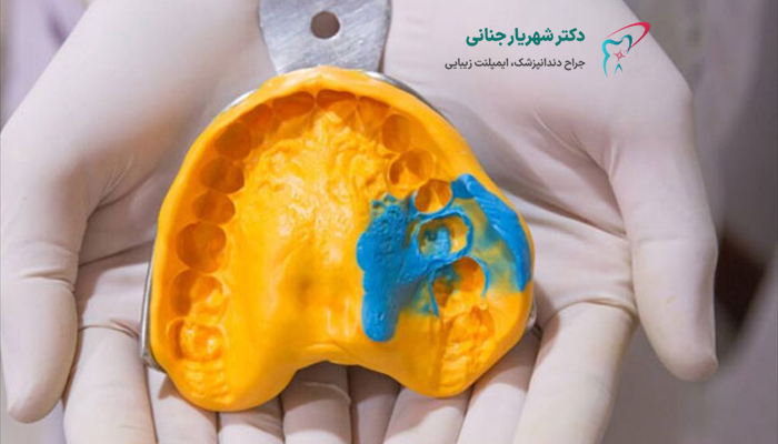 مزایای قالب گیری دیجیتال نسبت به روش سنتی