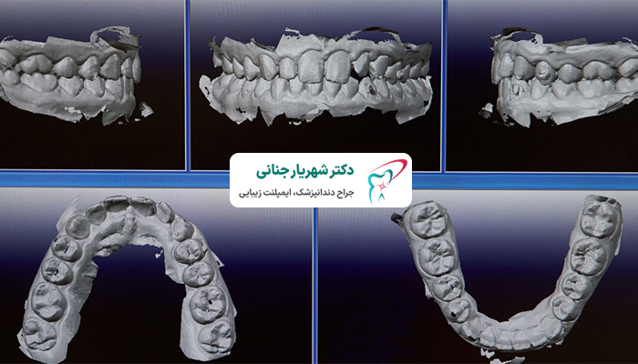 نتایج قالب گیری دیجیتال دندان چگونه است؟