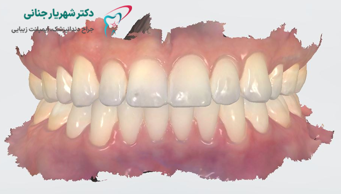 نمونه ای از اسکن دندان برای قالب گیری دیجیتال