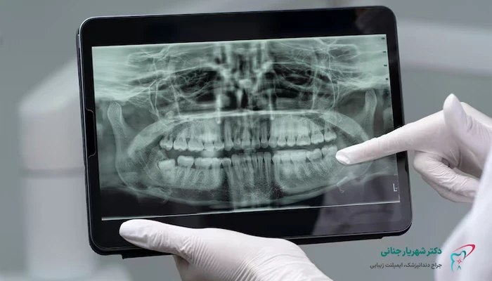 هزینه خدمات جانبی برای ایمپلنت دندان
