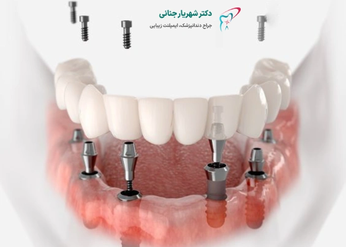 ایمپلنت دندان در کرج چگونه انجام میشود؟