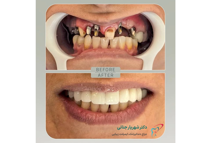 عکس قبل و بعد ایمپلنت دندان 1