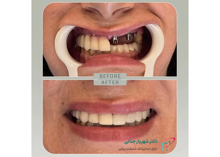 عکس قبل و بعد ایمپلنت دندان 2