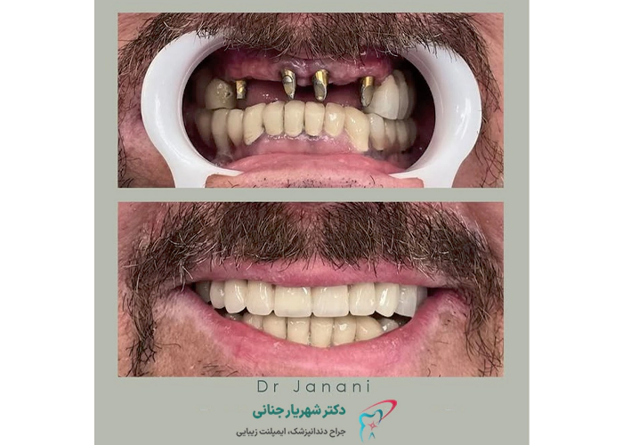 عکس قبل و بعد ایمپلنت دندان 3