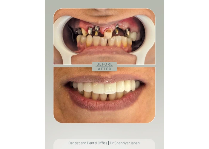 قبل و بعد ایمپلنت دندان در کلینیک جنانی