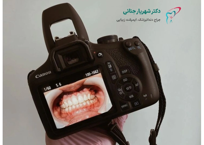 ماندگاری ایمپلنت دندان چقدر است؟