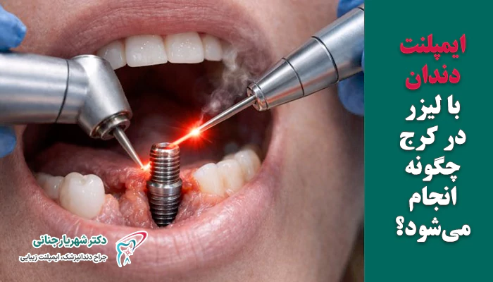 ایمپلنت دندان لیزری چگونه انجام میشود؟