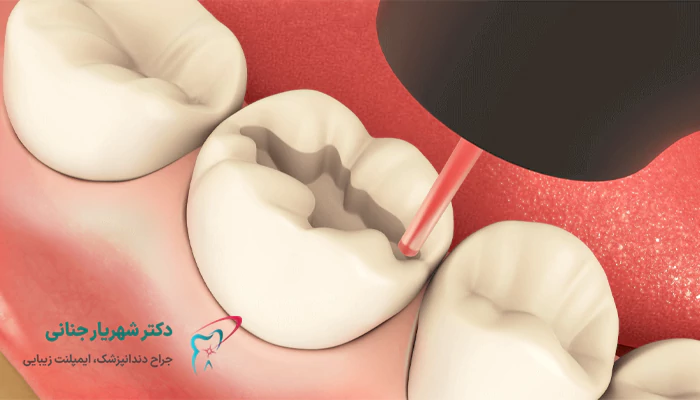 مراحل عصب کشی دندان با لیزر در کرج