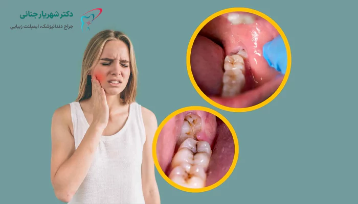 تفاوت جراحی دندان عقل سنتی و با لیزر