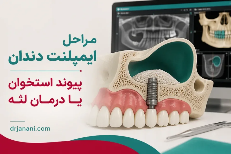 نمای توضیحی درباره پیوند استخوان یا درمان لثه