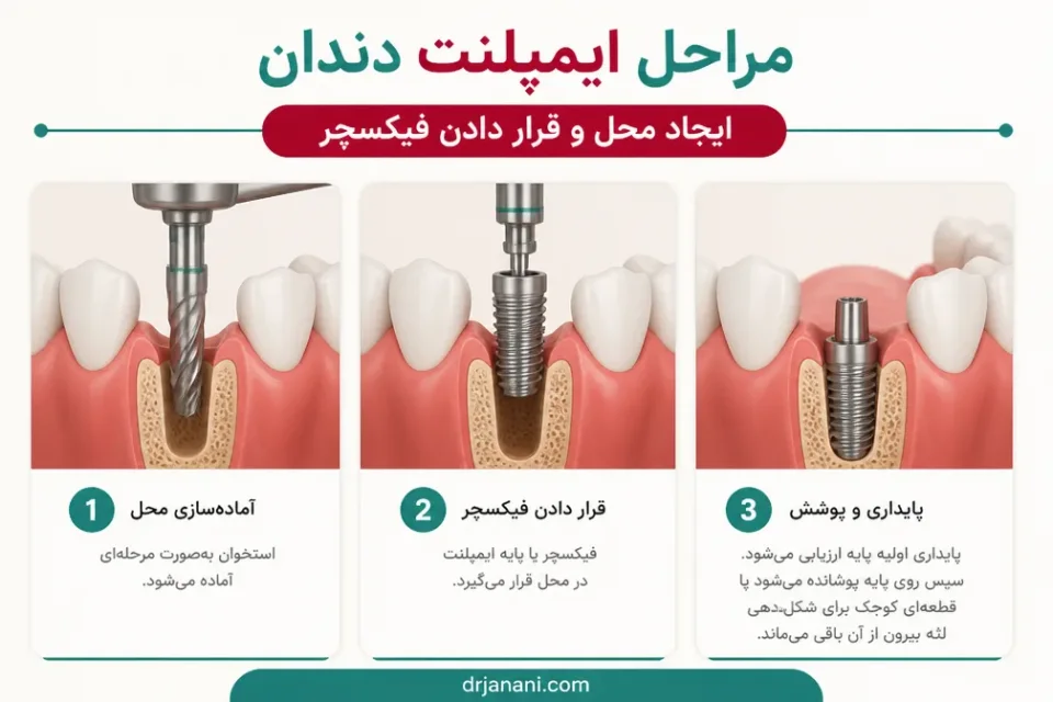 ایجاد محل و قرار دادن فیکسچر — قرار دادن پایه ایمپلنت در استخوان فک در مرحله جراحی