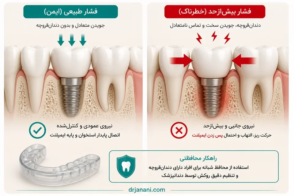 مقایسه فشار طبیعی و دندان قروچه روی ایمپلنت