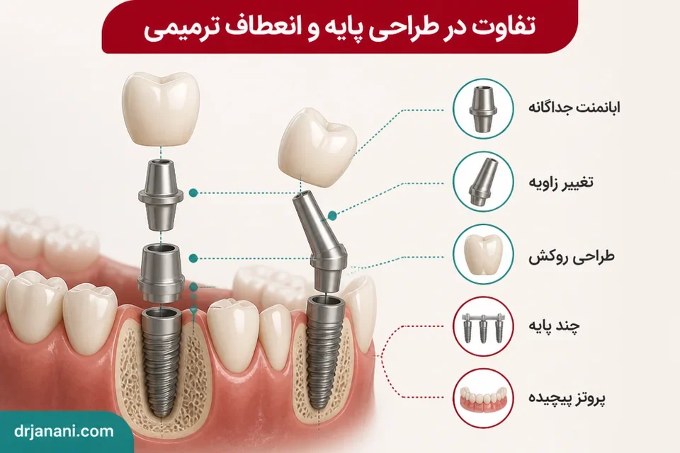 اجزای جداگانه و گزینههای ترمیمی ایمپلنت تیتانیوم