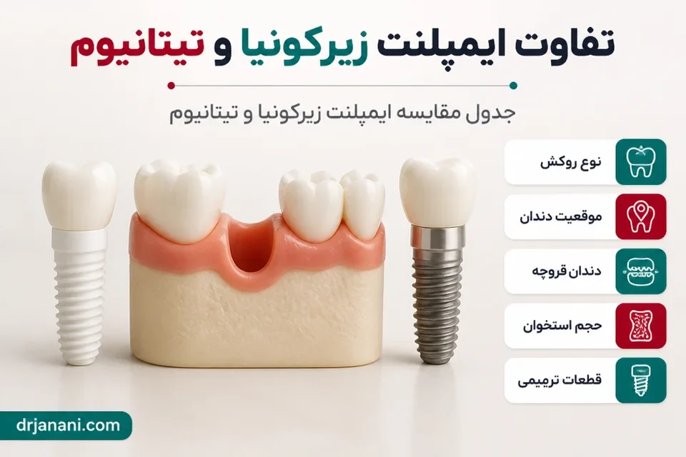 بررسی عوامل انتخاب میان ایمپلنت زیرکونیا و تیتانیوم