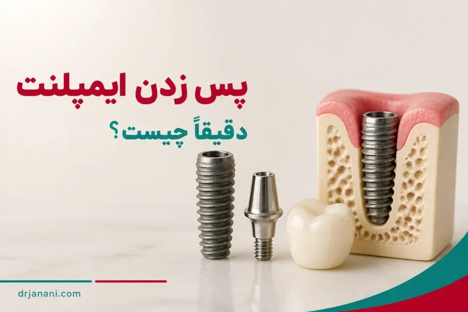 پس زدن ایمپلنت